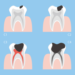 Stages of Dental Caries